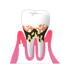 中度歯周病の場合