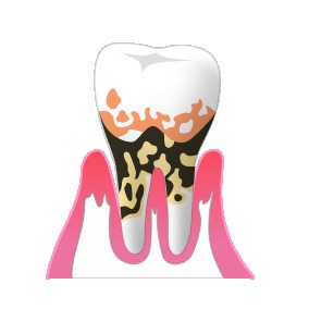 重度歯周病の場合